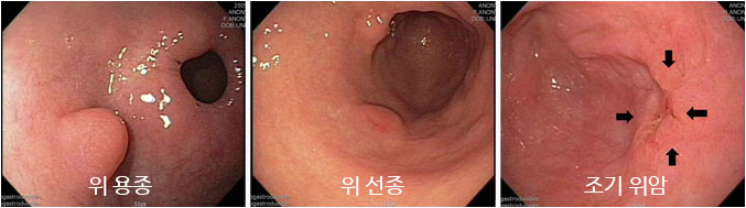 수면위내시경